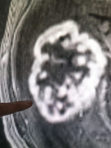 miRNAs spielen eine große Rolle bei Tumoren. (Archivbild)