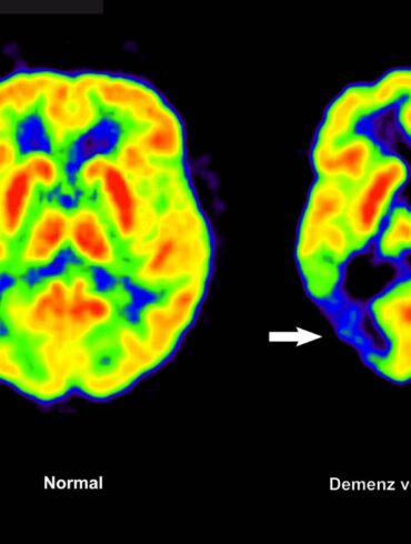 Haben die Amyloid-Plaques schon irreversible Schäden im Gehirn angerichtet, nützt ihre Entfernung nichts mehr. (Archivbild)